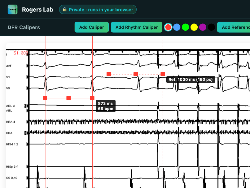 The DFR Calipers interface measuring intervals on a multi-lead electrogram — 873 ms, 69 bpm with a 1000 ms reference caliper